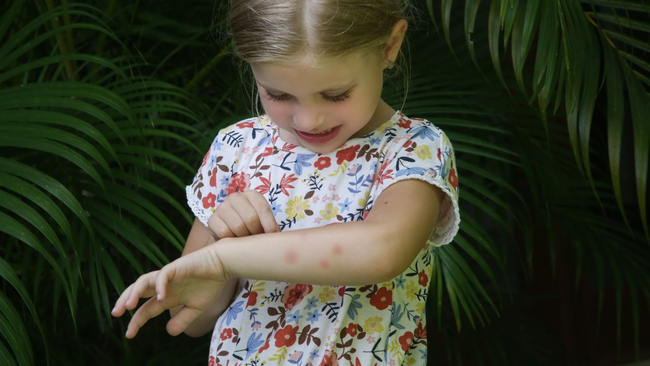 Insektenstichheiler-Test - Mädchen mit Mückenstichen